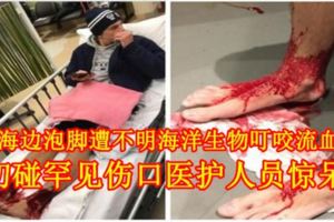 男子海邊泡腳遭不明海洋生物叮咬流血不止初碰罕見傷口醫護人員驚呆