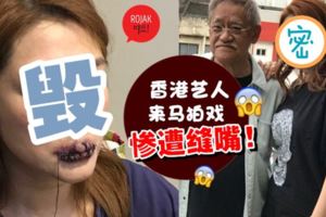 香港藝人來馬拍戲,慘遭縫嘴破相！畫面驚嚇,雙唇滿滿都是針線！現在斷水斷糧如廁困難…好可憐～