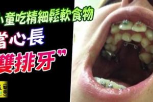 給小童吃精細鬆軟食物當心長「雙排牙」