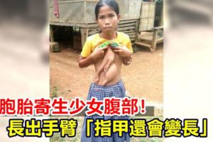 雙胞胎寄生少女腹部！長出手臂「指甲還會變長」