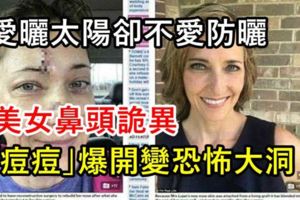 愛曬太陽卻不愛防曬,美女鼻頭詭異「痘痘」爆開變恐怖大洞