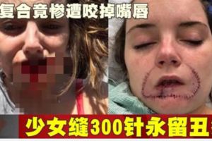 拒復合竟慘遭咬掉嘴唇少女縫300針永留丑疤!