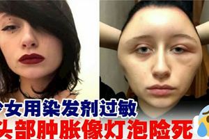 染發劑過敏少女頭部腫脹像燈泡險死