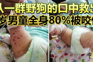 從一群野狗的口中救出1歲男童全身80%被咬傷