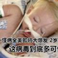 小心！一怪病全美即將大爆發2歲幼童喪命，這病毒到底多可怕？