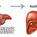 最傷肝的5種食物,一吃就傷肝,告訴家人要少吃!