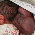 嬰兒患上腦膨出症，頭骨後突出了一個約1公斤重的腫塊