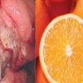 食道癌3症狀是早期信號！研究：柑橘降23％食道癌風險