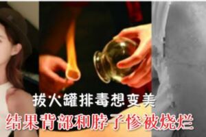 美女拔火罐排毒想變美結果背部和脖子慘被燒爛