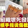 美女4根手指燙傷壞死　最後忍痛截肢