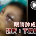 女童全身是傷！眼睛腫成2條縫，媽媽：下樓梯摔的