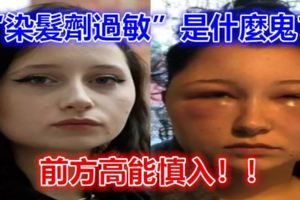 「染髮​​劑過敏」是什麼鬼？前方高能慎入！！