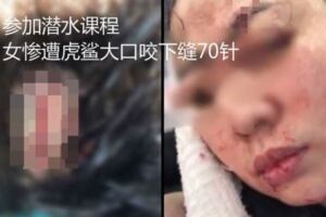 參加潛水課程女慘遭虎鯊大口咬下縫70針