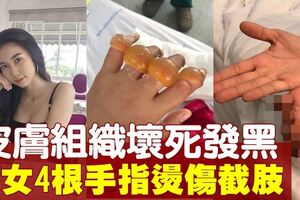 美女4根手指燙傷壞死　最後忍痛截肢