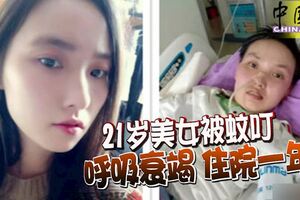 21歲美女被蚊叮呼吸衰竭住院一年