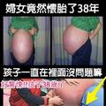 女怕動手術懷孕長達38年！網友：竟然不會自己掉下來！