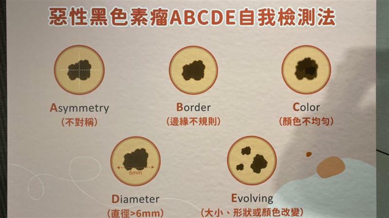 民眾可參考惡性黑色素瘤「ABCDE」自我檢查指標。（圖／記者簡浩正攝影）