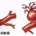 嘣！血管上的「炸彈」爆了，專家：這個年齡是道坎