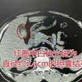 男子反覆腹脹腹痛以為「腫瘤」 一查才知背後真兇竟是它