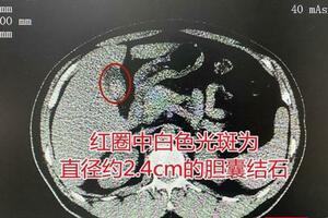 男子反覆腹脹腹痛以為「腫瘤」 一查才知背後真兇竟是它