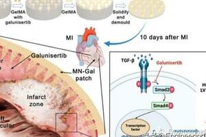 負載 Galunisertib 的GelMA微針貼片，用於心肌梗塞後心臟修復