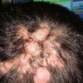 頭發中長了很多包，紅腫疼痛，頭發中長痘痘？如何區分是上火引起還是頭部毛囊炎？