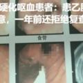 28歲肝硬化嘔血患者：患乙肝十幾年吃藥隨意，一年前還拒絕復查