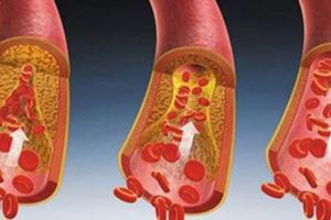 這4個信號暗示同一件事：你的血脂已經很高了，趕緊制止！