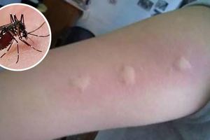 被蚊子叮過總是腫一包又越抓越癢，教你三招止癢方法，60秒後止癢去痕！