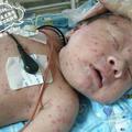 出生16天寶寶出水痘，媽媽竟然是「元兇」