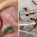 居然有螞蟻在印度女孩的耳朵裡築巢，醫生夾出上千隻螞蟻後，發現到一件更可怕的事實…