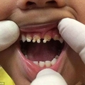 5 歲男孩乳牙全毀，可能造成永久缺牙，兇手竟然是全球大受歡迎的...！真是太恐怖了！！
