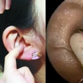 曾鴻鉦醫師（台中市世鴻耳鼻喉科）喜歡挖耳朵的人一定要看！看完你還敢亂挖嗎？