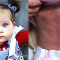 當外國媽媽為了“濕疹”3年的女兒絕望時，華裔媽媽竟然用一條小偏方就救了她！太神奇了！