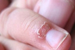 你的手指常常脫皮「倒刺指」嗎？千萬不要直接把皮撕下來，你應該要這樣做才對！