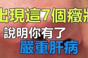 醫生：出現這7個癥狀，說明你有了嚴重肝病​！千萬注意！