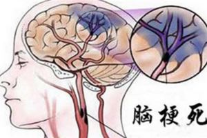 心腦血管醫生提醒：牢記一個字，讓你一生無「栓」