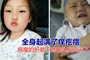 5歲女孩患白血病面目全非，身起滿了癢疙瘩，對媽媽說我不想死