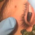 17歲男孩眼睛紅腫「吃消炎藥」也無效，進醫院做檢查竟發現…！手術時全體醫生護士都「尖叫」了！