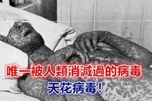 唯一被人類消滅過的病毒——天花病毒！密恐慎入…..