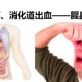 這樣的屁，小心腸癌！「屁」大點事兒能看出大問題！