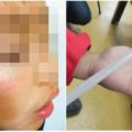 國小生被用熱熔膠條「打臉」紅腫，菜鳥班導凌虐學童被記申誡懲處！