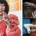 16歲花季少女患「怪病」，皮膚變黑變硬脫落，好心人義演募捐救治