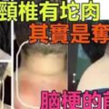 「頸椎有坨肉號稱富貴包」其實是奪命包～是腦梗的前兆，教你3招解決它！