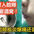 少女想變美要可愛酒窩竟鋼釘入臉頰發炎爆痛還留疤