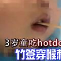 千萬不可以讓孩子在跑跳時吃東西！3歲童吃hotdog跌倒-竹簽穿喉刺腦干!