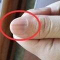 如果手指指甲上出現這條線，要當心是惡癌來襲！