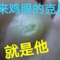 原來治療雞眼那麼簡單，不到一個星期全好啦