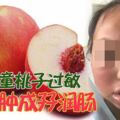 女童桃子過敏一口腫成孖潤腸