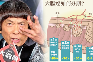 豬哥亮癌逝享壽70歲 大腸癌分期不可不慎！